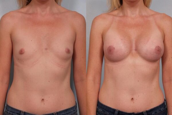 Breast Augmentation 215