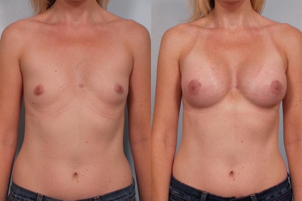 Breast Augmentation 215