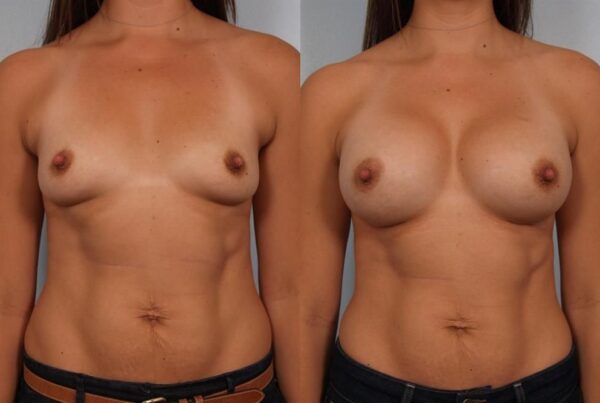 Breast Augmentation 216
