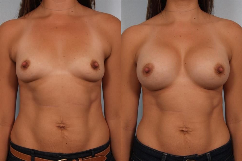 Breast Augmentation 216