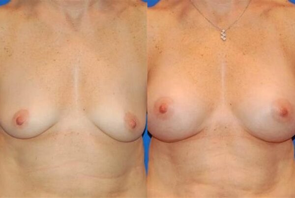 Breast Augmentation 217