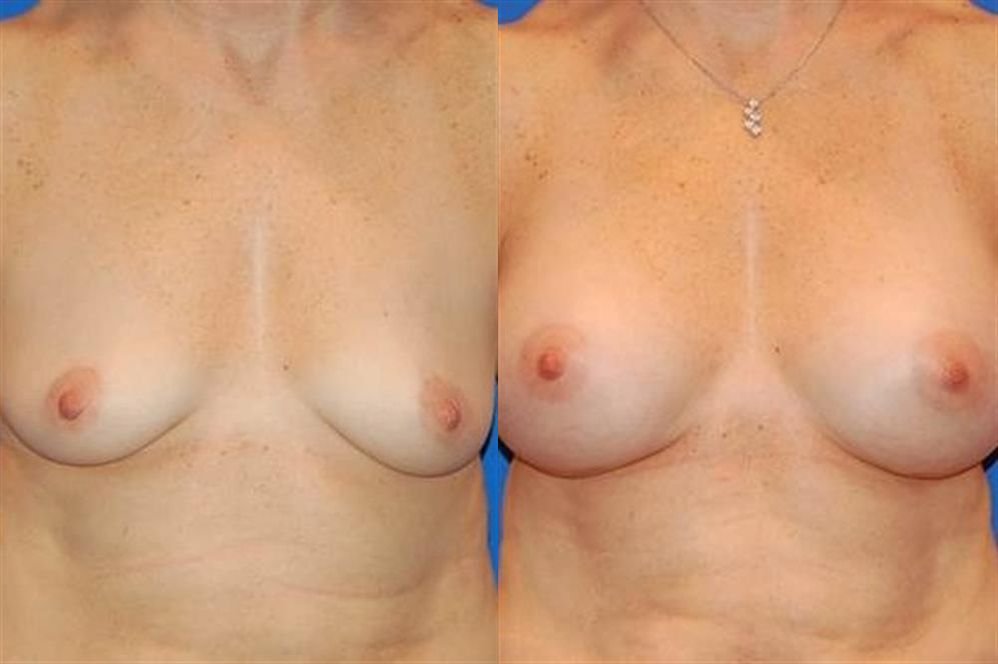 Breast Augmentation 217