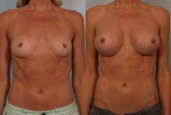Breast Augmentation 218