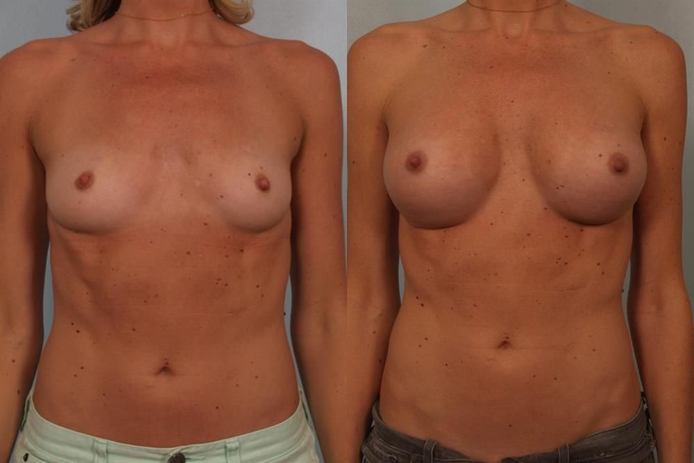 Breast Augmentation 218