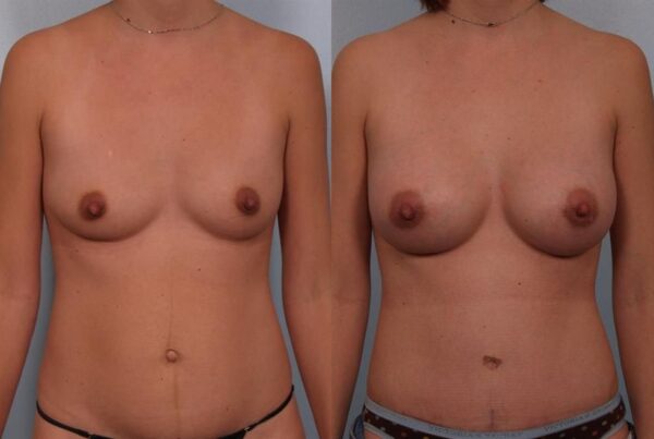 Breast Augmentation 219