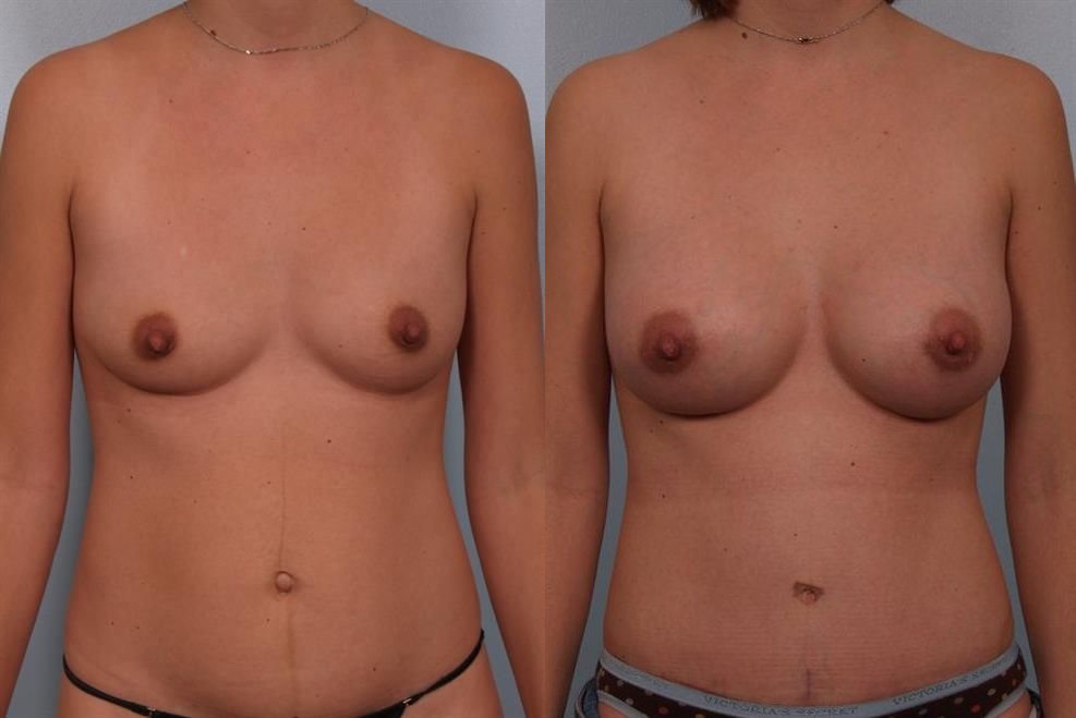 Breast Augmentation 219