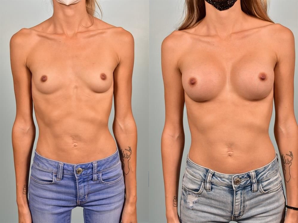 Breast Augmentation 22