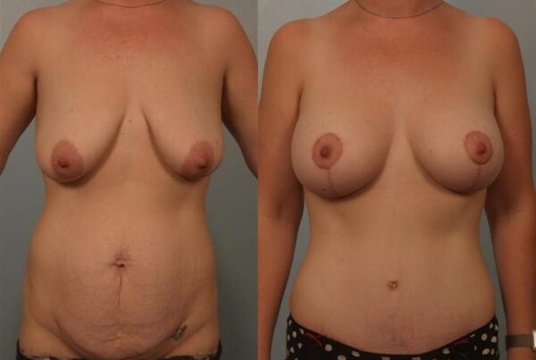 Breast Augmentation 221