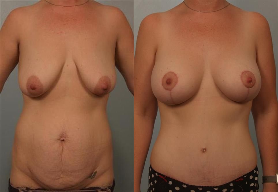 Breast Augmentation 221