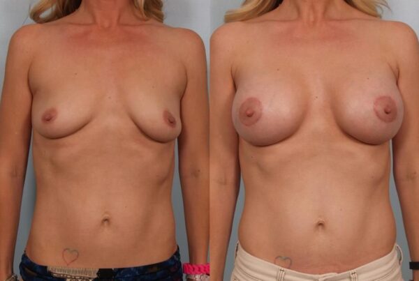 Breast Augmentation 222