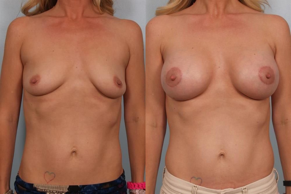 Breast Augmentation 222