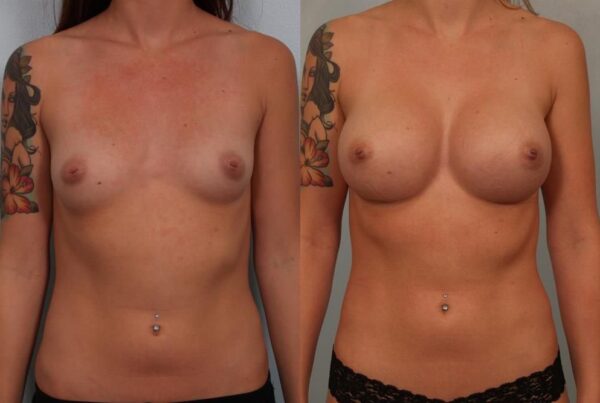 Breast Augmentation 223