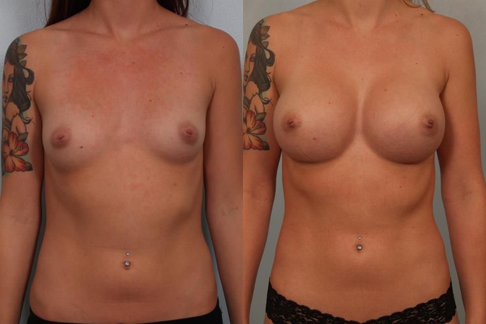 Breast Augmentation 223