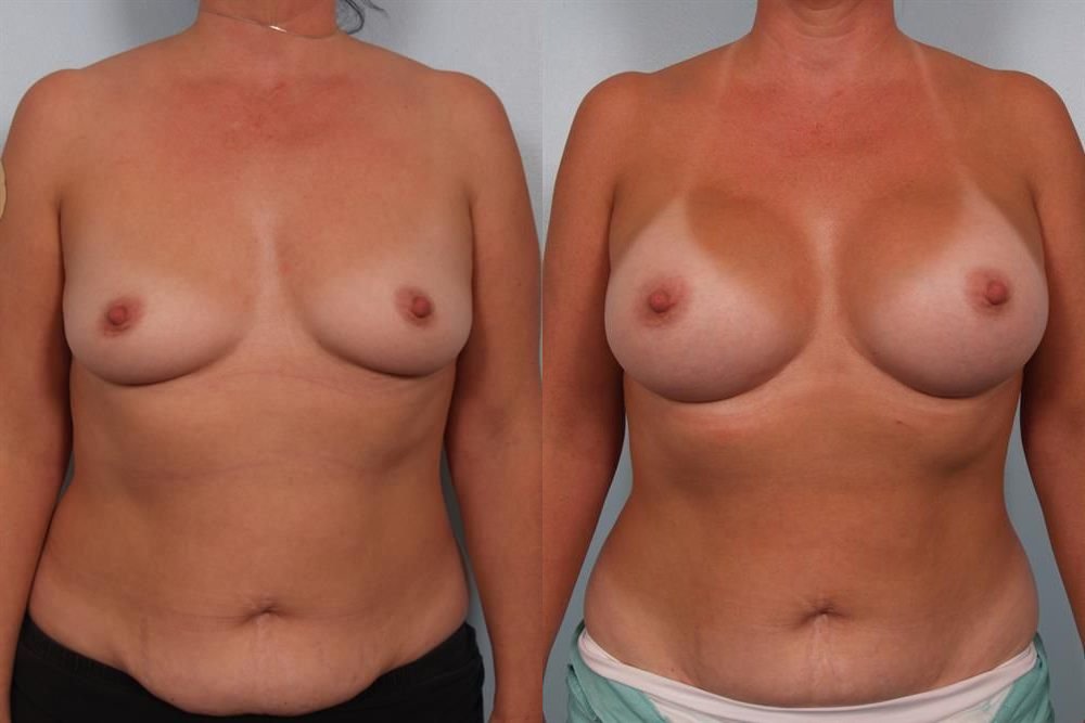 Breast Augmentation 224