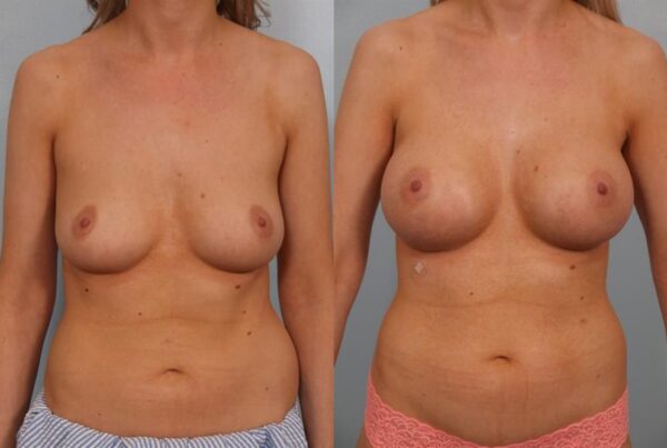 Breast Augmentation 225