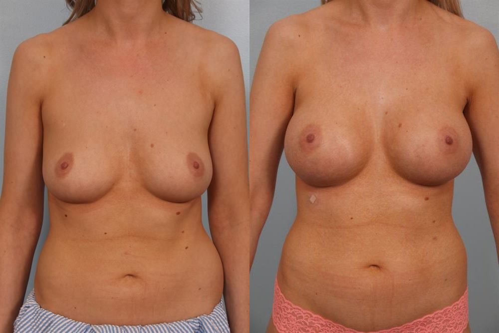 Breast Augmentation 225