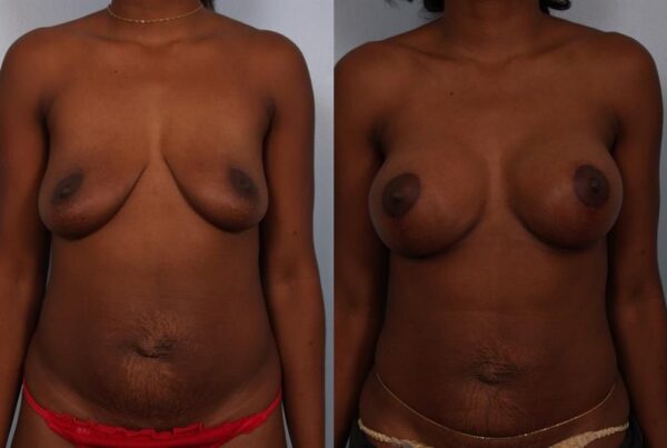 Breast Augmentation 226