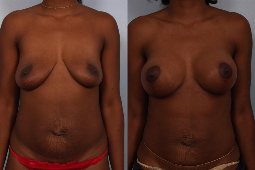 Breast Augmentation 226