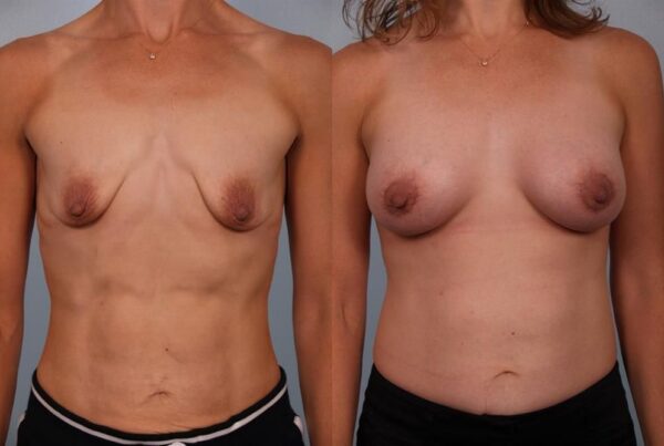 Breast Augmentation 227