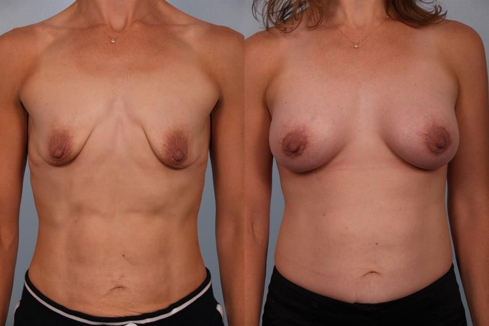 Breast Augmentation 227