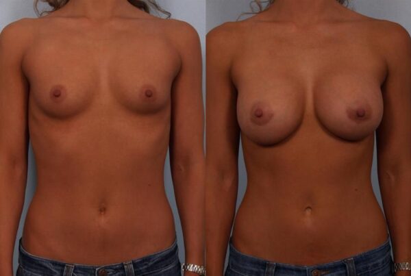 Breast Augmentation 228