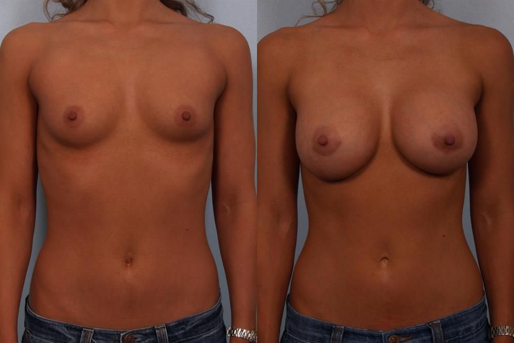 Breast Augmentation 228