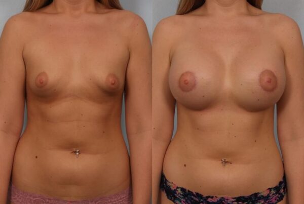 Breast Augmentation 229