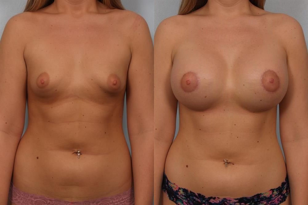 Breast Augmentation 229