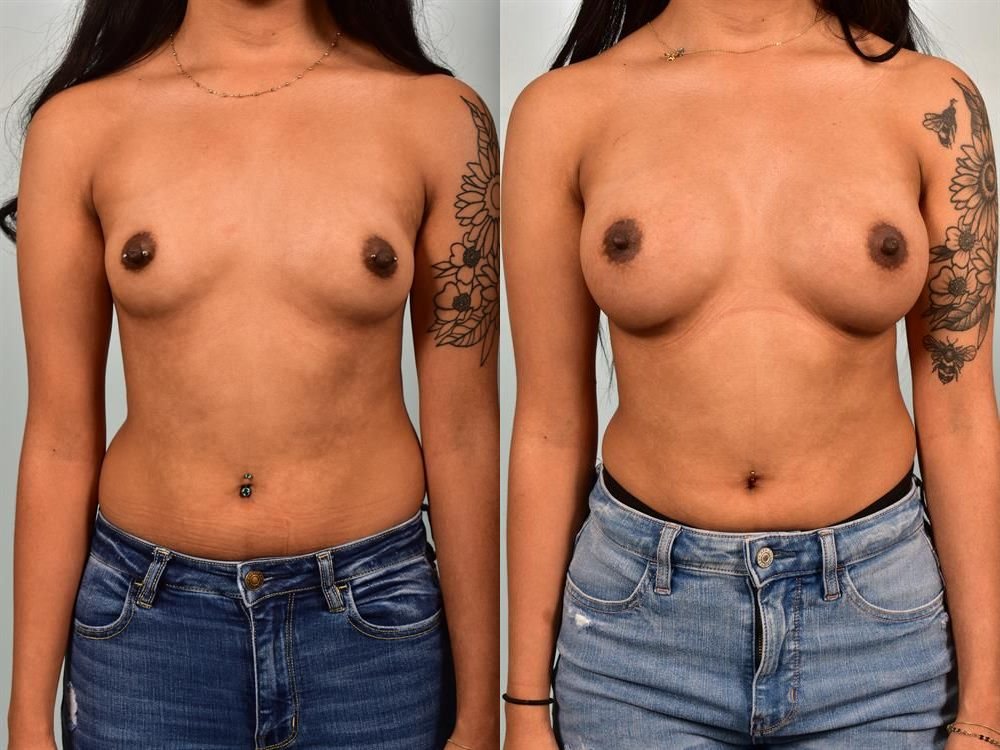 Breast Augmentation 23
