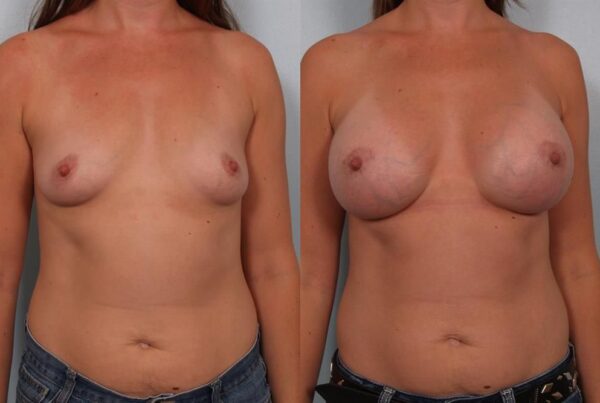 Breast Augmentation 230