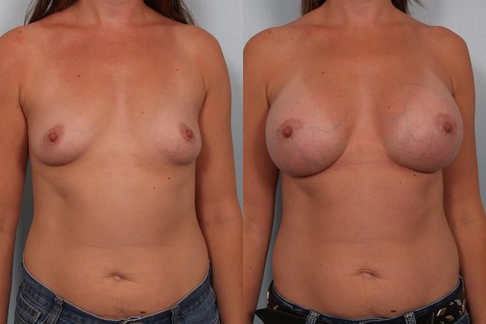 Breast Augmentation 230