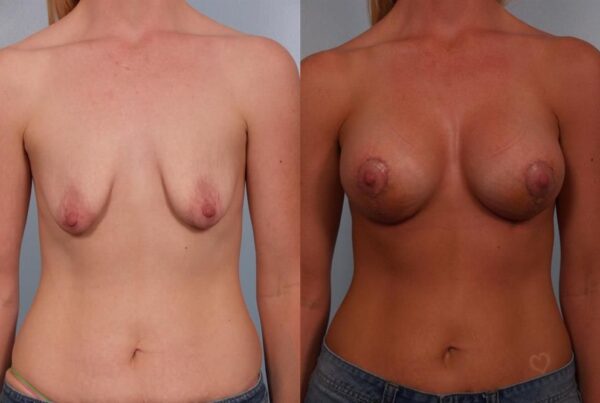 Breast Augmentation 231