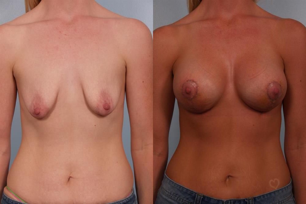 Breast Augmentation 231