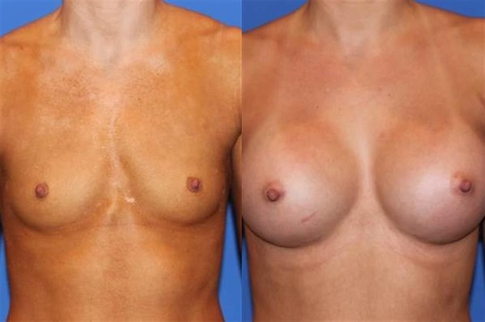 Breast Augmentation 232