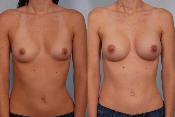 Breast Augmentation 233