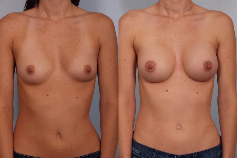 Breast Augmentation 233
