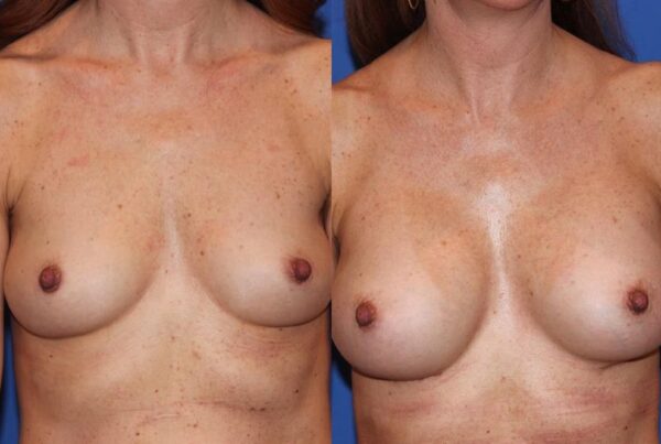 Breast Augmentation 234