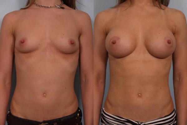 Breast Augmentation 235