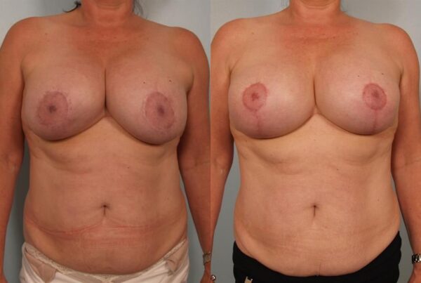 Breast Augmentation 236