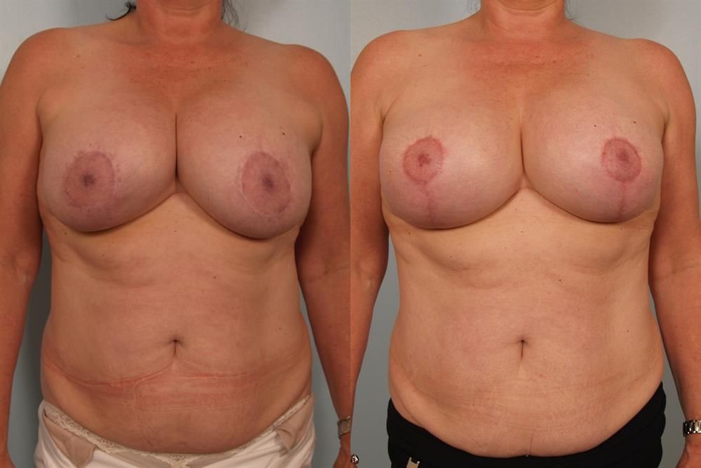 Breast Augmentation 236