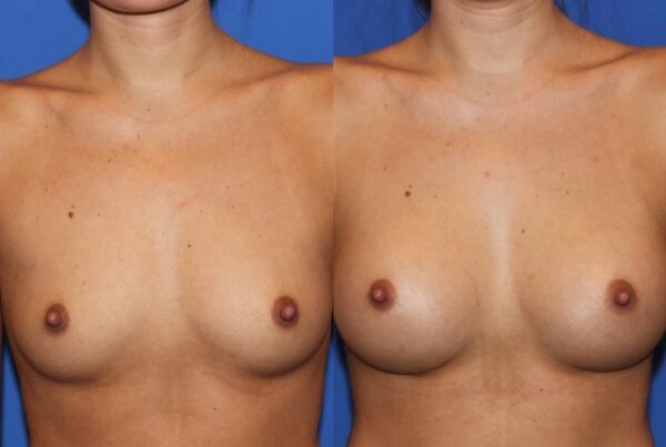 Breast Augmentation 237