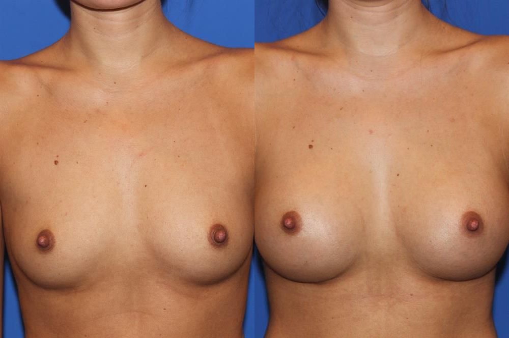 Breast Augmentation 237