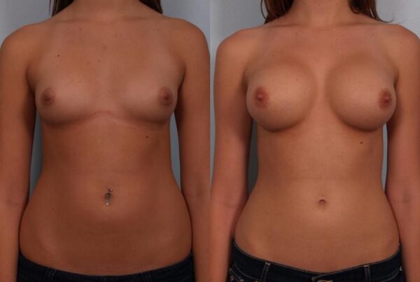Breast Augmentation 238