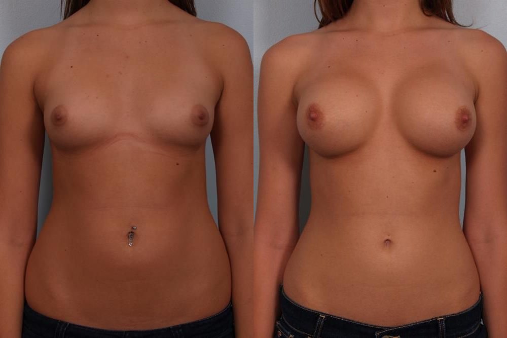 Breast Augmentation 238
