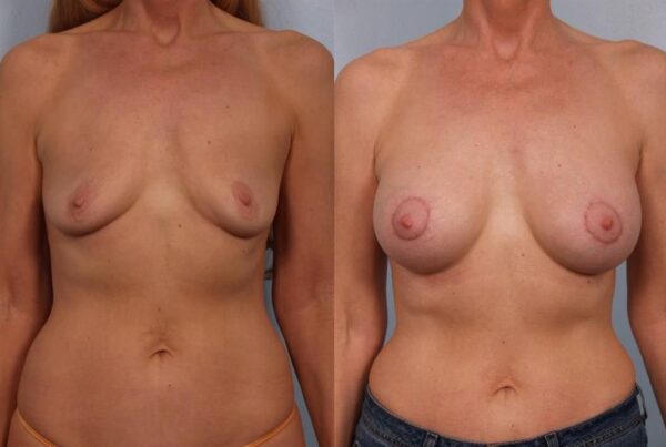 Breast Augmentation 239
