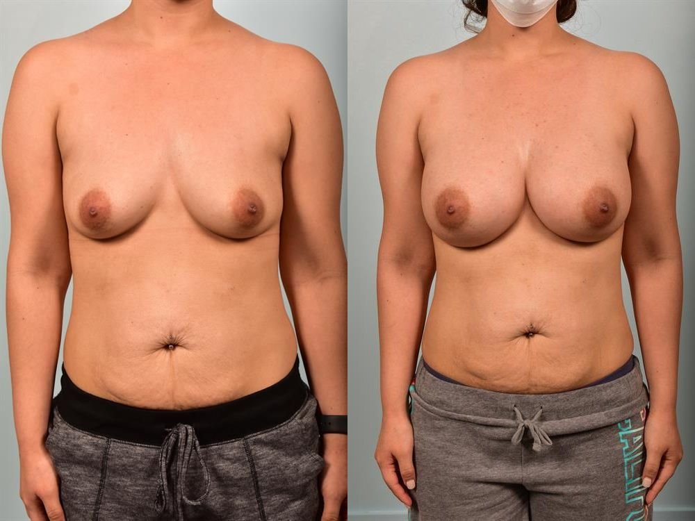 Breast Augmentation 24