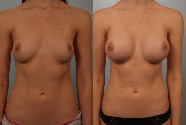Breast Augmentation 240