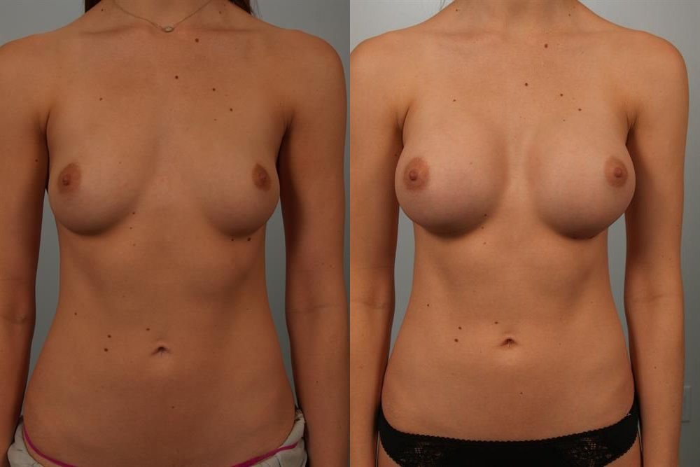 Breast Augmentation 240