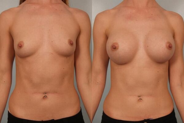 Breast Augmentation 241