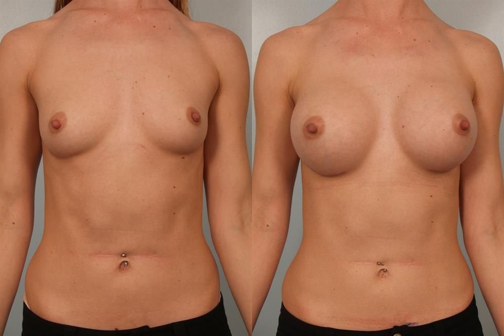 Breast Augmentation 241